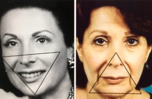 Comparativo em preto e branco de rosto antes e depois do rejuvenescimento facial.