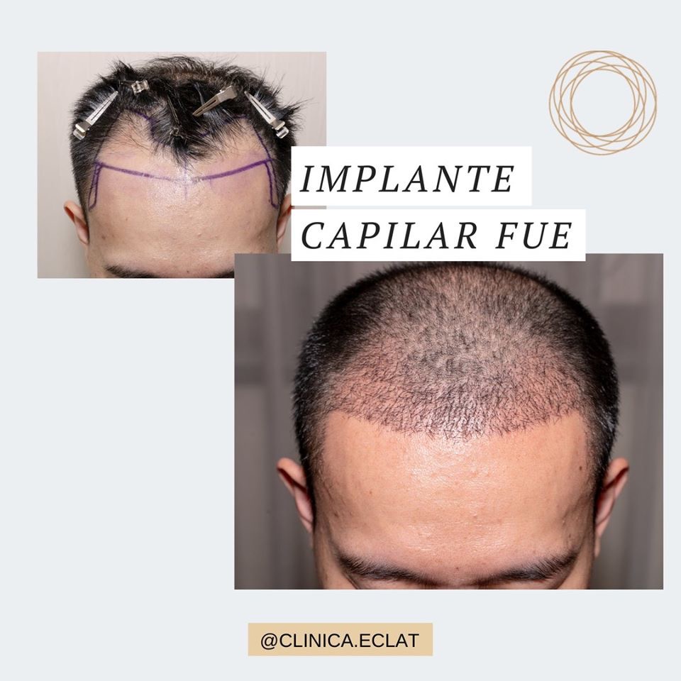 Implante Capilar