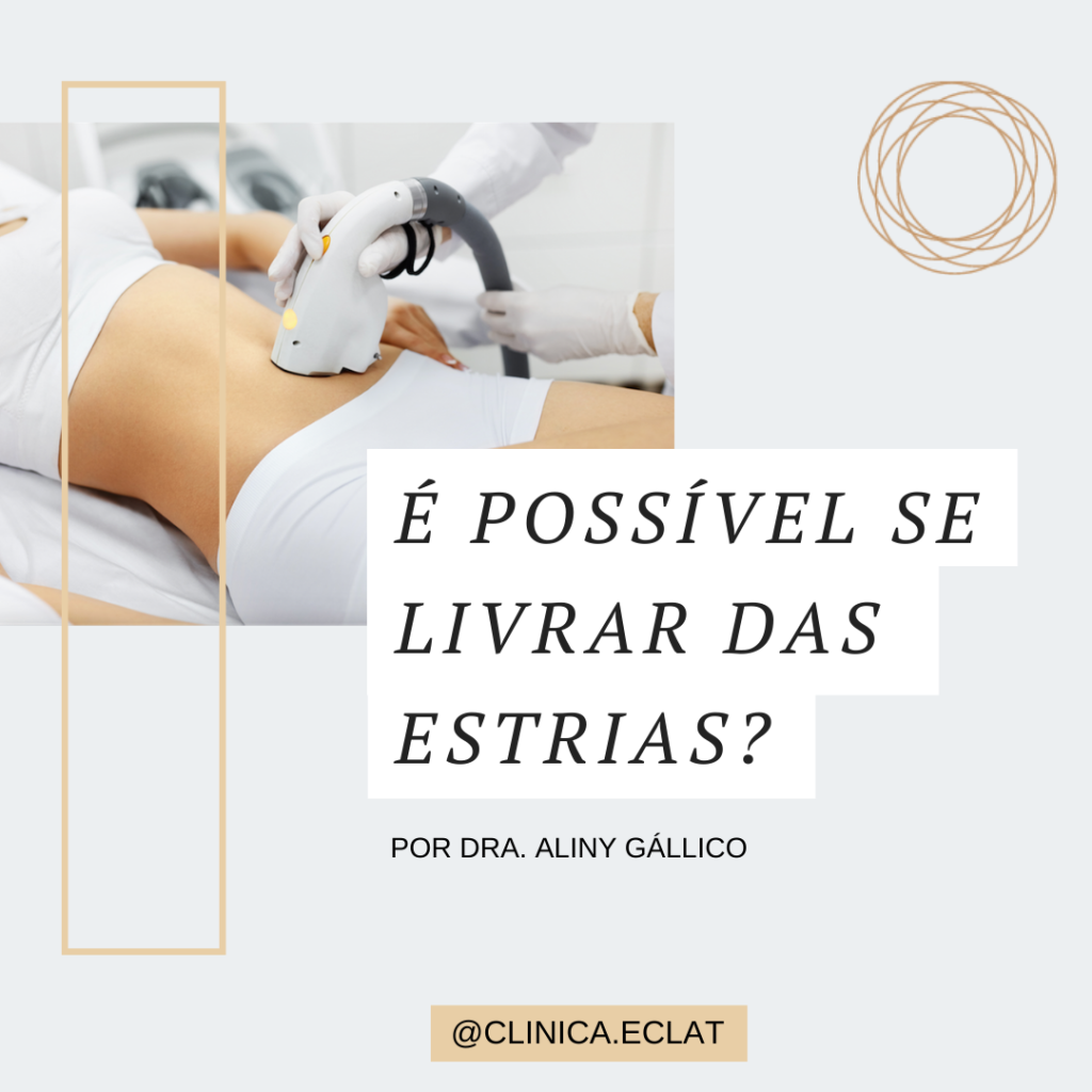 É possível se livrar das estrias?