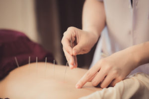 Acupuntura