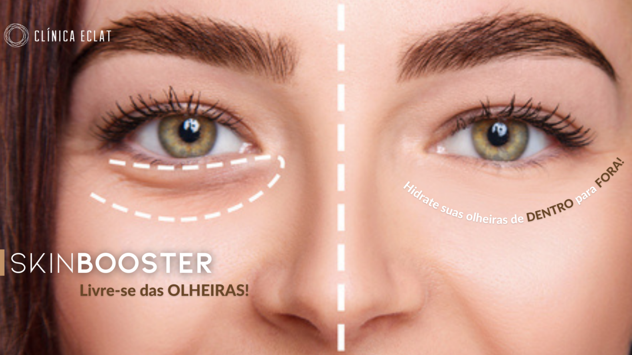 Livre-se das Olheiras - Conheça o Skinbooster / Preenchimento | Clínica ...