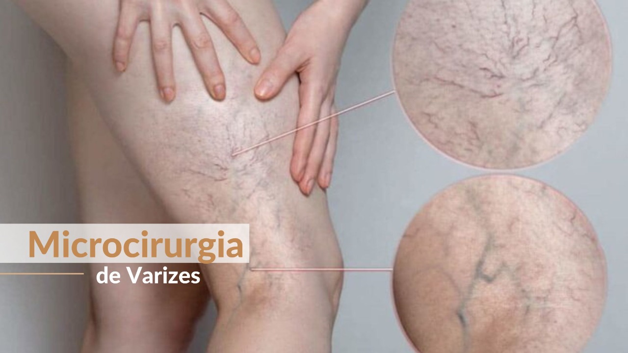 Microcirurgia de Varizes: Acabe com a dor nas pernas!