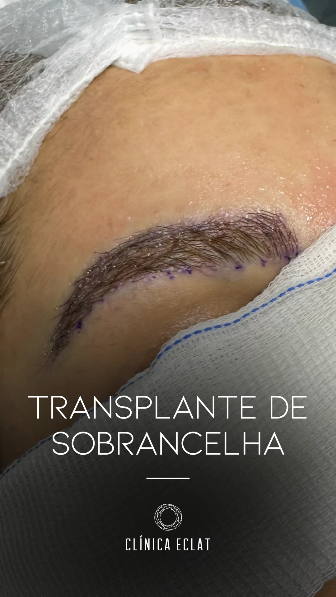 transplante-sobrancelha